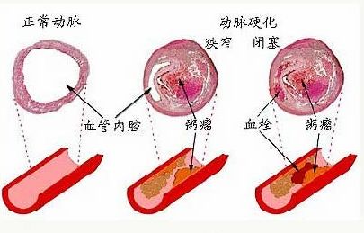 动脉硬化.jpg