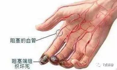 当深静脉血栓在四肢生成时,就会造成手或者腿的水肿.